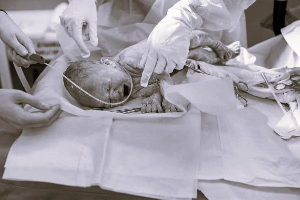 envato-a-newborn-baby-lies-on-the-operating-table-for-resized-b-w-1024x681